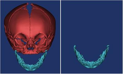 Measurement of the normal mandible in neonates in east China